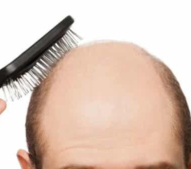 CALVÍCIE (ALOPECIA ANDROGENÉTICA)}