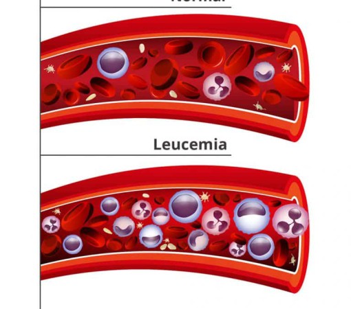 TIPOS DE LEUCEMIA}