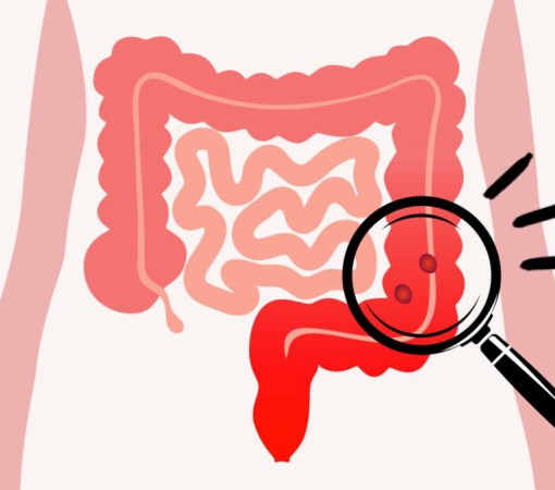 CÂNCER DE INTESTINO}
