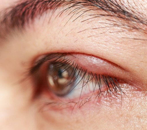 BLEFARITE: O QUE É E COMO TRATAR A INFLAMAÇÃO NA PÁLPEBRA}