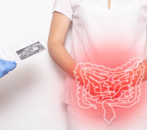 DIVERTICULITE E DIVERTICULOSE}