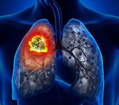 EMBOLIA PULMONAR}