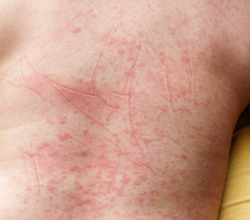 DENGUE CLÁSSICA, DENGUE HEMORRÁGICA E DENGUE COM COMPLICAÇÕES}