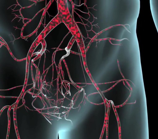 ANEURISMA DA AORTA ABDOMINAL: CAUSAS, DIAGNÓSTICO E TRATAMENTO}