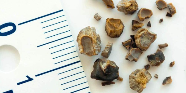 PEDRA NOS RINS - CÁLCULO RENAL