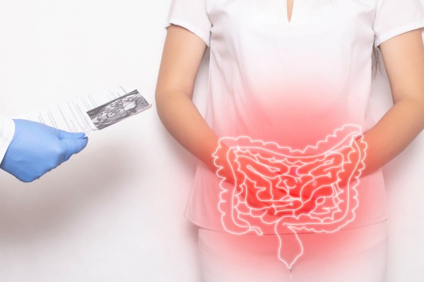 DIVERTICULITE E DIVERTICULOSE}