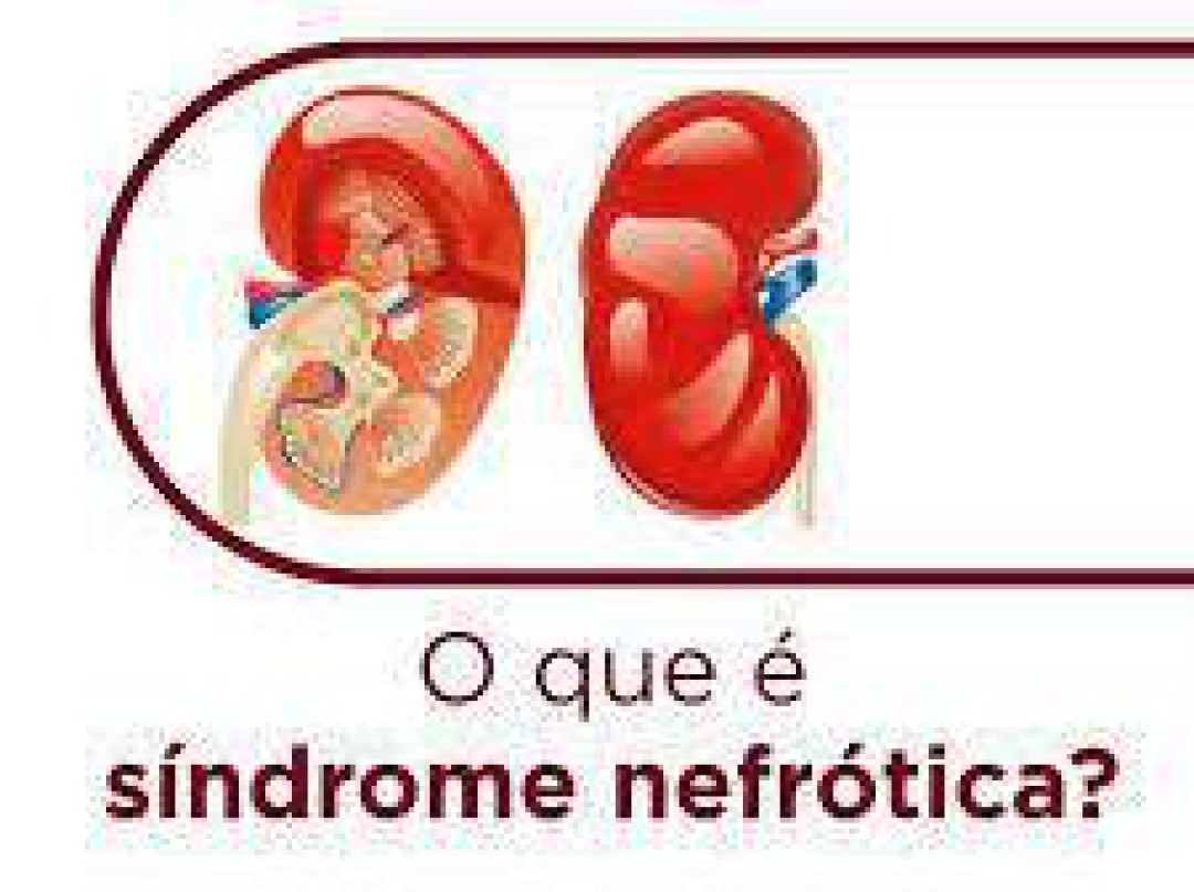 SÍNDROME NEFRÓTICA