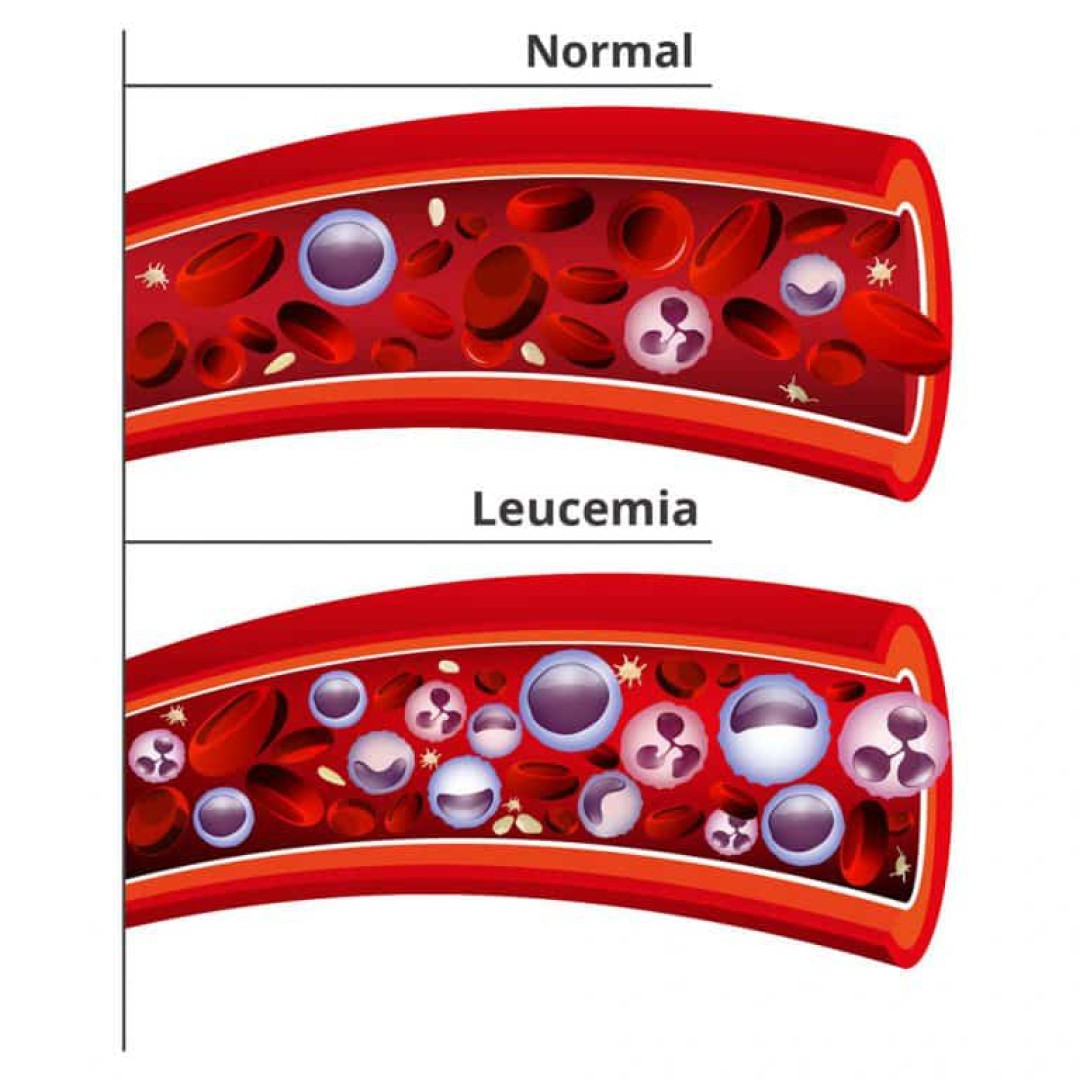 TIPOS DE LEUCEMIA