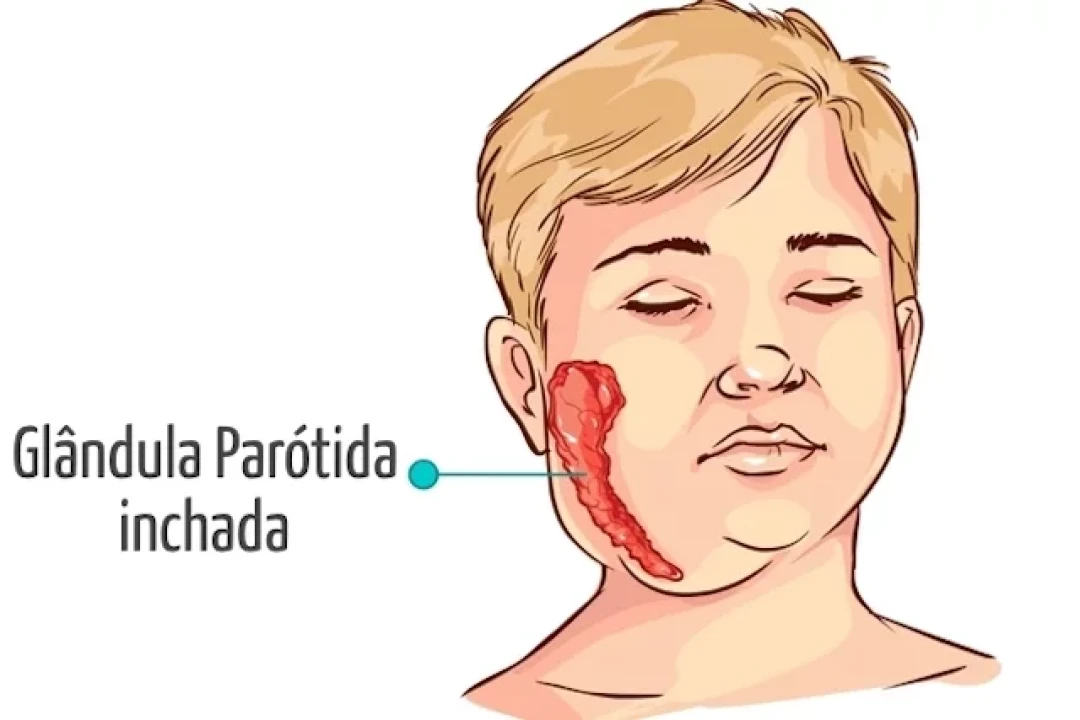 COMO RECONHECER OS SINTOMAS DA CAXUMBA