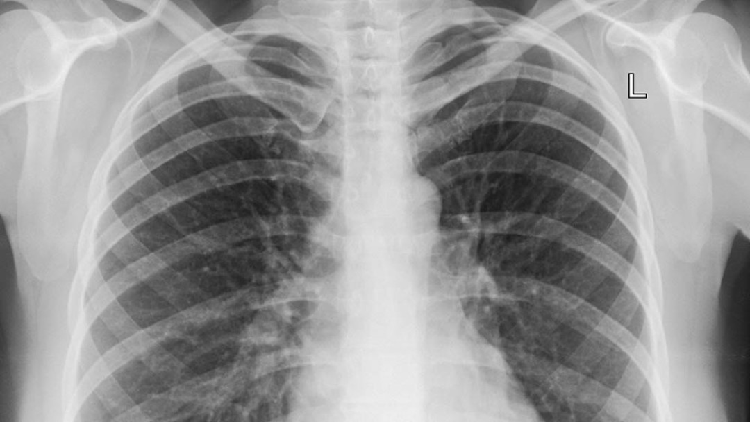 PNEUMONIA - CUIDADOS E RECOMENDAÇÕES