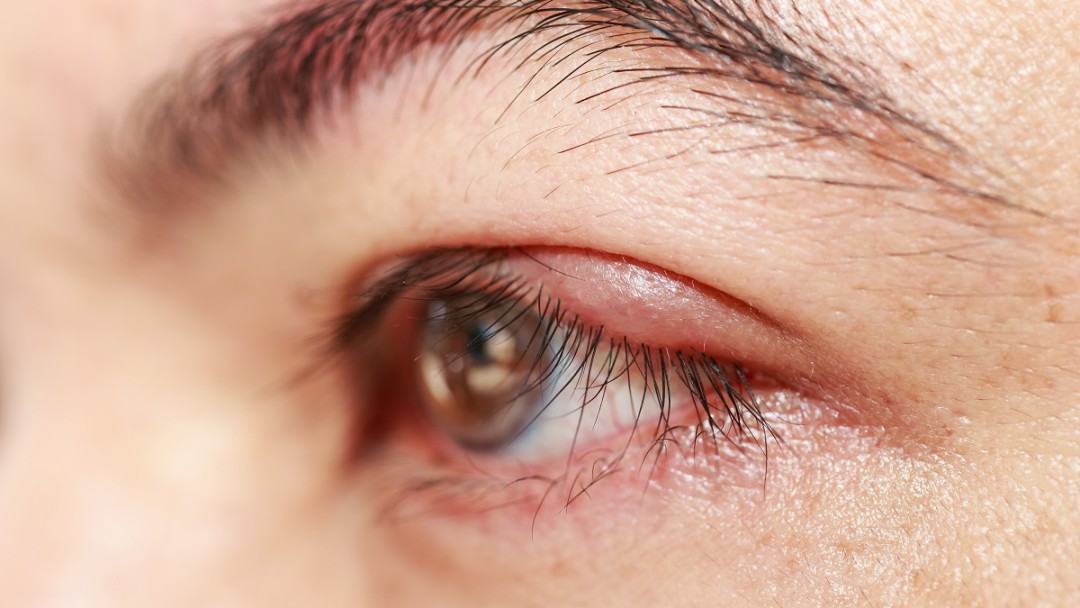 BLEFARITE: O QUE É E COMO TRATAR A INFLAMAÇÃO NA PÁLPEBRA