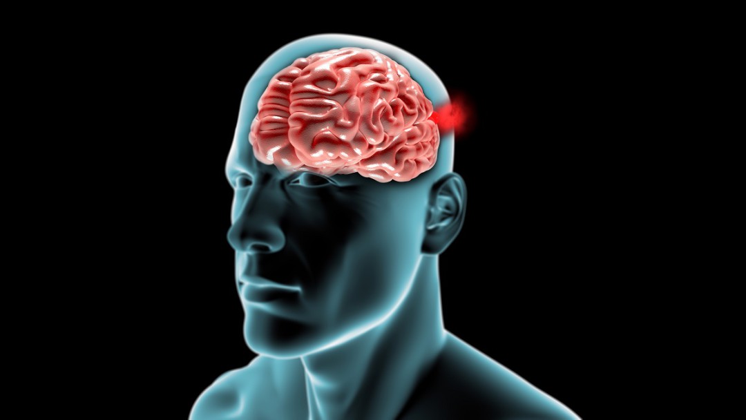 ANEURISMA CEREBRAL