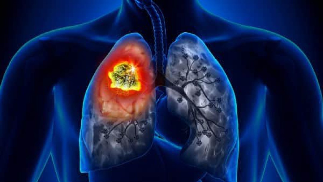 EMBOLIA PULMONAR