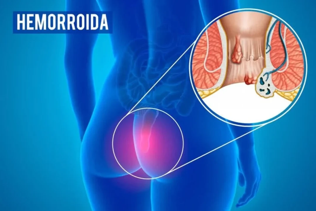 Sente dores fortes no ânus ou reto e não sabe o que é? Pode ser hemorroida,  doença caracterizada - InMeD