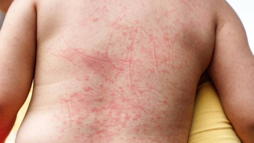 DENGUE CLÁSSICA, DENGUE HEMORRÁGICA E DENGUE COM COMPLICAÇÕES