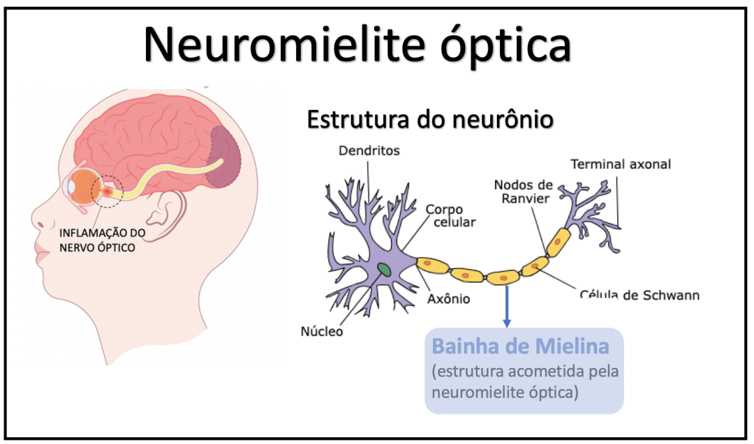 DOENÇA DO ESPECTRO DA NEUROMIELITE ÓPTICA