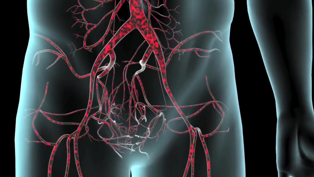 ANEURISMA DA AORTA ABDOMINAL: CAUSAS, DIAGNÓSTICO E TRATAMENTO